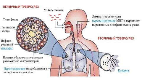 як лікують хворих на туберкульоз