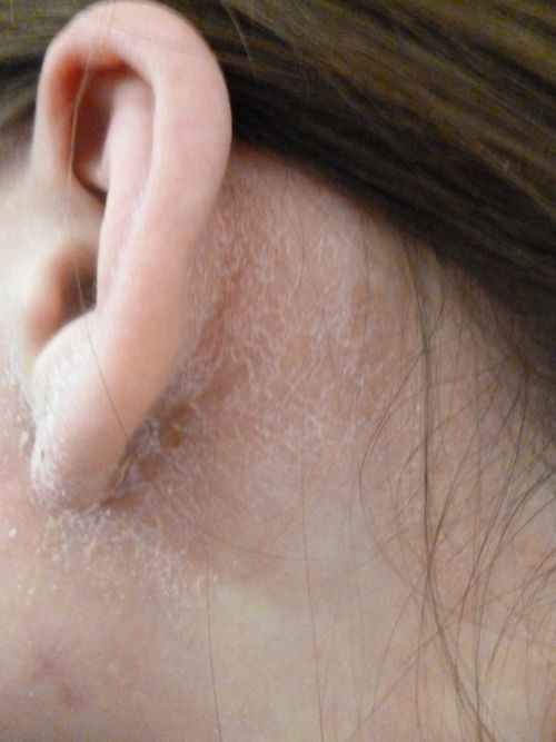 як лікувати себорейний дерматит у вухах