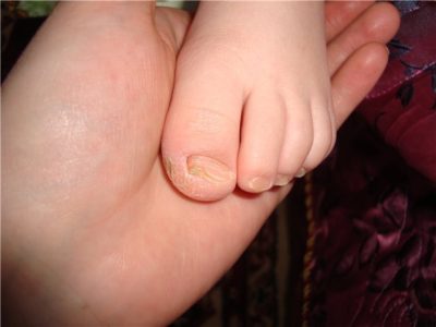 як лікувати жовті нігті на ногах
