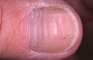 як лікувати ребристі нігті