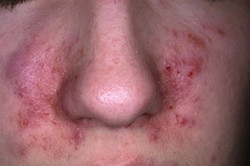 періоральний дерматит прищі навколо рота у чоловіків у жінок причини лікування