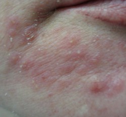 періоральний дерматит прищі навколо рота у чоловіків у жінок причини лікування