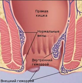 препарати від геморою