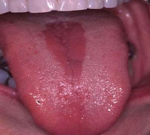 причини тріщин на язику дорослого