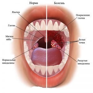 як вилікувати прищі в горлі