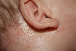 як лікувати прищі за вухами