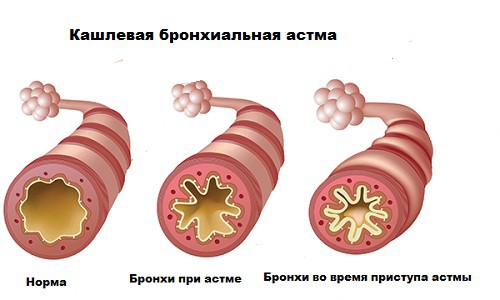 як лікувати Кашльові астму