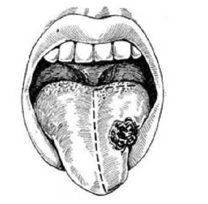як лікувати рак кореня язика
