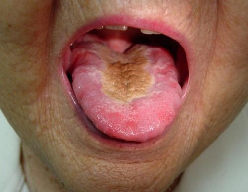 як лікувати рак кореня язика