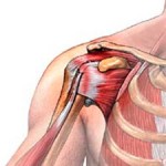 як лікувати розтягнення плеча
