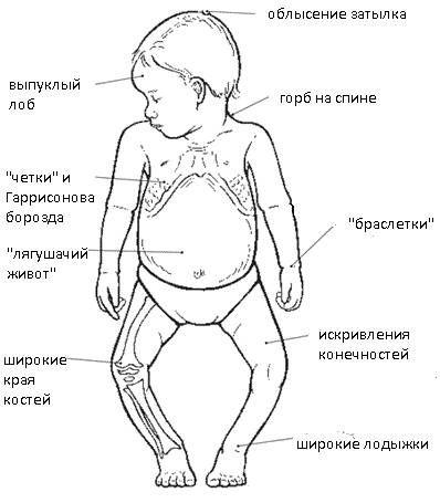 як лікувати рахіт у 3 місяці