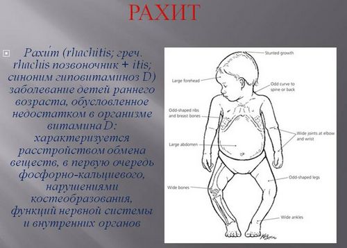 як лікувати рахіт у дитини