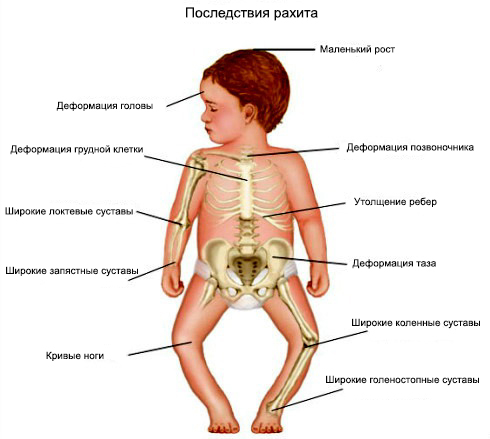 як лікувати наслідки рахіту