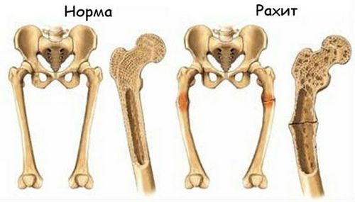 як лікувати наслідки рахіту