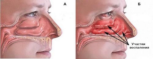 риніт нежить ніс запалення пазухи віруси бактерії причини симптоми лікування вагітні гострий сухий хронічний