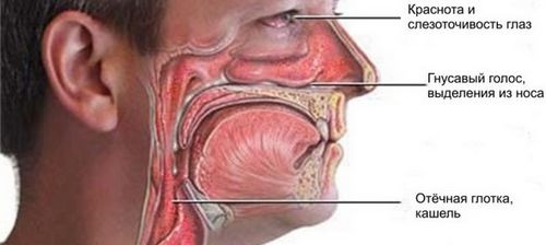 риніт нежить ніс запалення пазухи віруси бактерії причини симптоми лікування вагітні гострий сухий хронічний