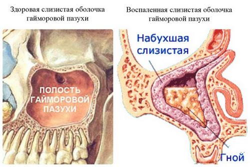 як лікувати риніт і синусит