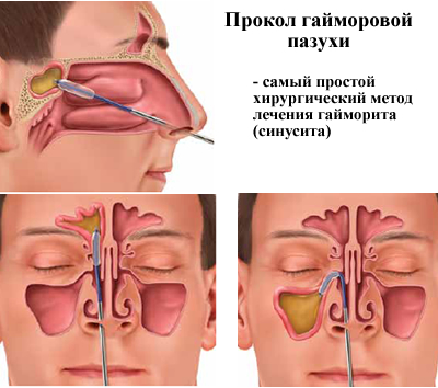 як лікувати риніт і синусит