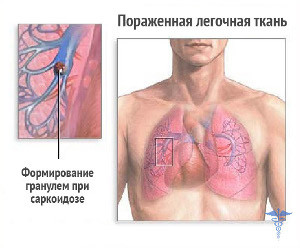 діагностика саркоїдозу легенів