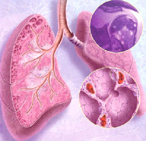 діагностика саркоїдозу легенів