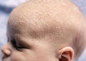 алергія себорейниє скоринки немовлята фото