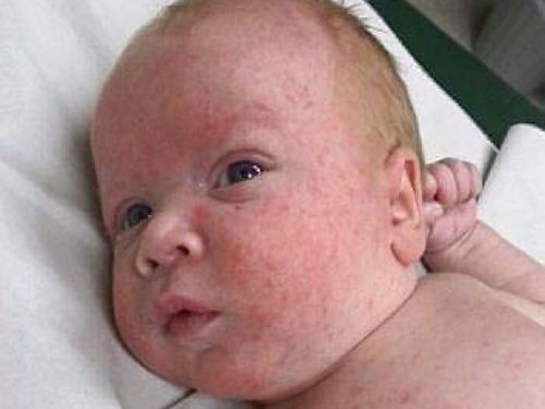 як лікувати дерматит у немовлят