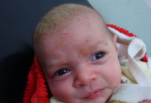 себорейний дерматит дітей грудничка лікування новонароджених фото