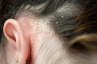як лікувати лущення за вухами