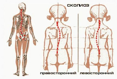 як лікувати викривлення шиї