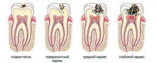 як лікувати середній карієс