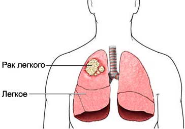 як лікувати рак легенів 3 стадія