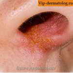 як лікувати стрептодермії у носі