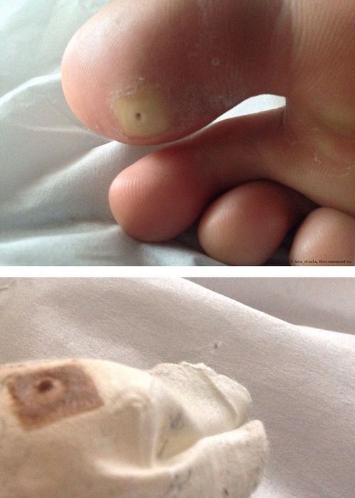 суха мозоль на пальцях ніг лікування підошві стопи як позбутися фото видалення в домашніх умовах