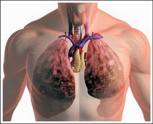 як лікувати тромбоемболії легенів