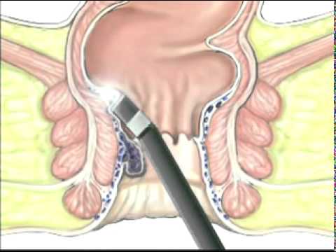 як лікувати геморой лазером