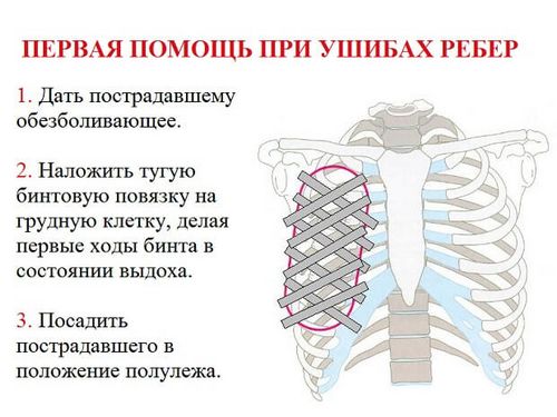 як лікувати забій ребра