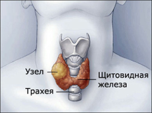 небезпека вузли щитовидна залоза