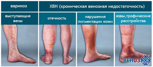 варикозне розширення вен на ногах стадії початкова варикоз як лікувати ранніх стадіях лікування