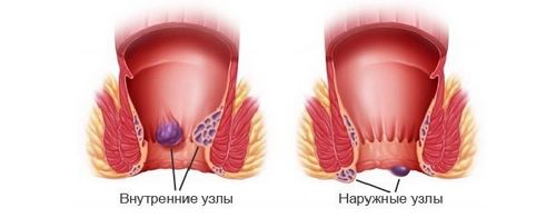 як вилікувати варикоз у чоловіків