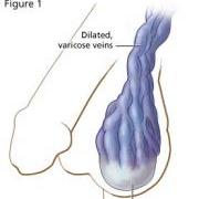 як лікувати варикоз в яєчках