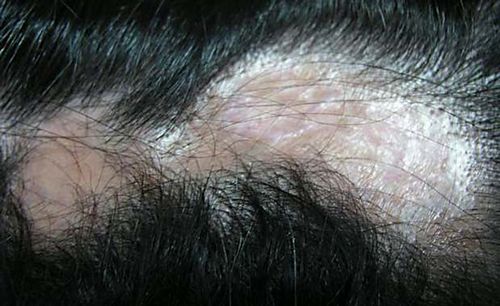 як лікувати випадання волосся у чоловіків