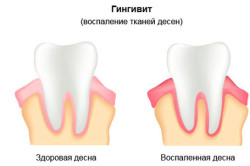 як лікувати ясна вагітним