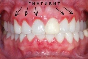 Запалення ясен при вагітності - лікування гінгівіту як лікувати ясна під час вагітності