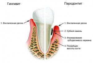 як лікувати ясна під час вагітності