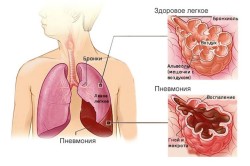 пульмонолог будинку