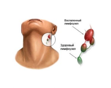 як лікувати хворі лімфовузли