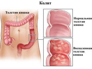 як лікувати товстий кишечник