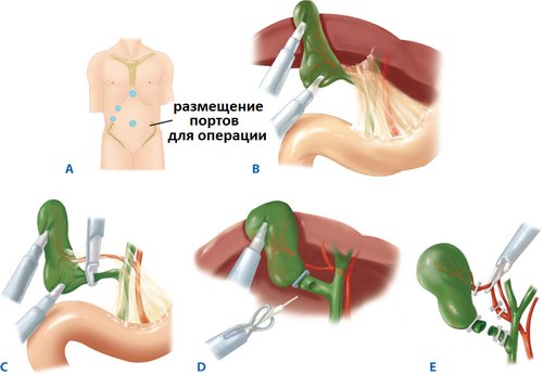 холедохолітіаз причини симптоми ускладнення діагностика лікування конкременти жовчні протоки міхур операція