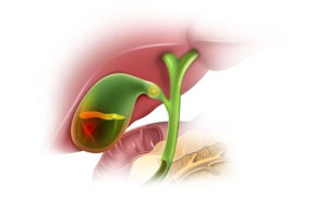 як лікують холецистит в стаціонарі