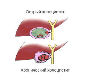 холецистит симптоми і лікування у дорослих